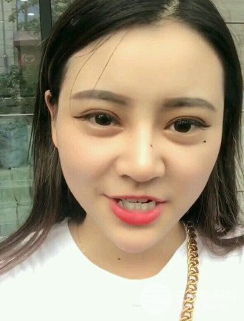 西安切開(kāi)雙眼皮開(kāi)眼角手術(shù)案例恢復(fù)過(guò)程圖分享