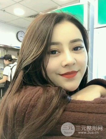 西安切開(kāi)雙眼皮開(kāi)眼角手術(shù)案例恢復(fù)過(guò)程圖分享