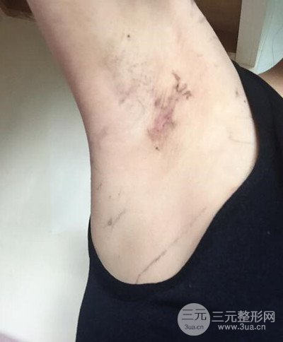 假體隆胸手術(shù)恢復(fù)記錄，豐滿大胸不是夢(mèng)