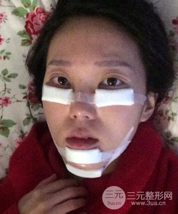 深圳內(nèi)切去眼袋+硅膠墊下巴真實(shí)案例恢復(fù)果圖
