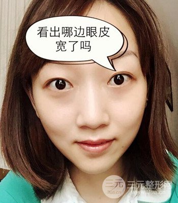 北京雙眼皮失敗修復(fù)手術(shù)日記分享，附上前后對(duì)比照片