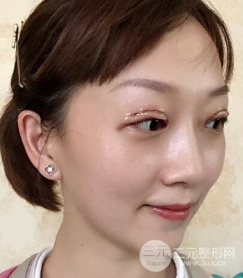 北京雙眼皮失敗修復(fù)手術(shù)日記分享，附上前后對(duì)比照片