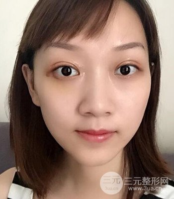北京雙眼皮失敗修復(fù)手術(shù)日記分享，附上前后對(duì)比照片