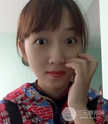 北京雙眼皮失敗修復(fù)手術(shù)日記分享，附上前后對(duì)比照片