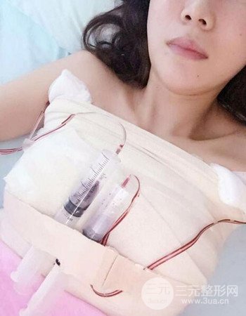 上海假體隆胸真人日記手術(shù)果分享,從A到D不是夢