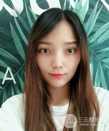 雙眼皮失敗修復(fù)手術(shù)日記分享,改變雙眼皮不對(duì)稱