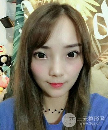 雙眼皮失敗修復(fù)手術(shù)日記分享,改變雙眼皮不對(duì)稱