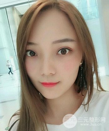 雙眼皮失敗修復(fù)手術(shù)日記分享,改變雙眼皮不對(duì)稱