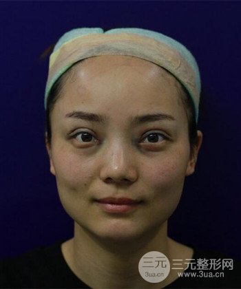 雙眼皮失敗修復(fù)手術(shù)日記分享,改變雙眼皮不對(duì)稱