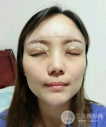 雙眼皮失敗修復(fù)手術(shù)日記分享,改變雙眼皮不對(duì)稱