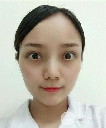 雙眼皮失敗修復(fù)手術(shù)日記分享,改變雙眼皮不對(duì)稱