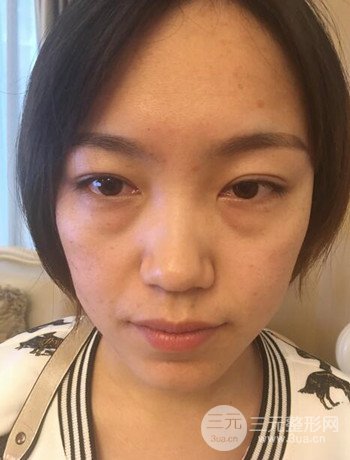 北京內(nèi)切祛眼袋真人案例果對比分享,年輕十歲不是夢