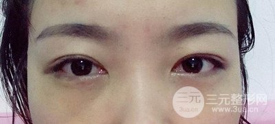 北京內(nèi)切祛眼袋真人案例果對比分享,年輕十歲不是夢