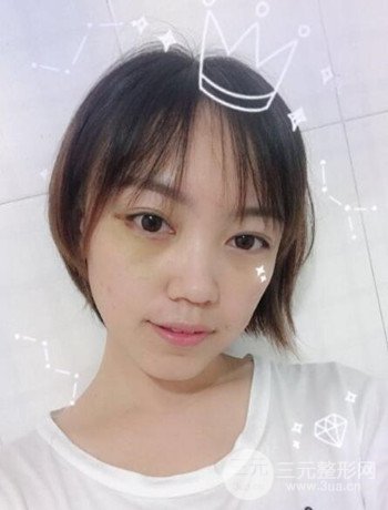 北京內(nèi)切祛眼袋真人案例果對比分享,年輕十歲不是夢