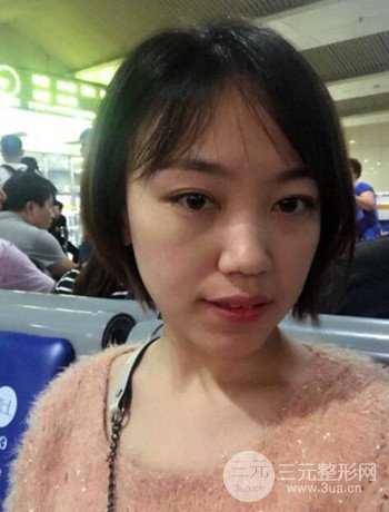 北京內(nèi)切祛眼袋真人案例果對比分享,年輕十歲不是夢