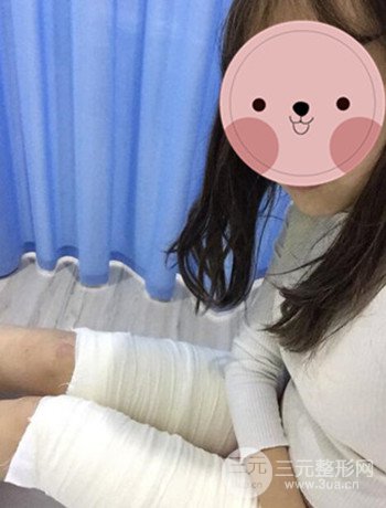 吸脂瘦大腿手術(shù)經(jīng)歷分享,纖細雙腿不再是夢