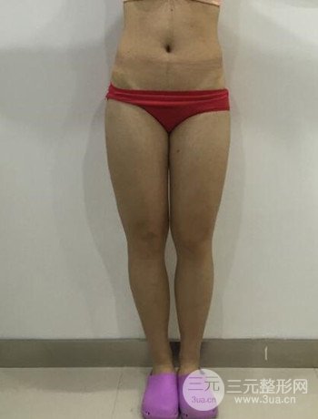 吸脂瘦大腿手術(shù)經(jīng)歷分享,纖細雙腿不再是夢