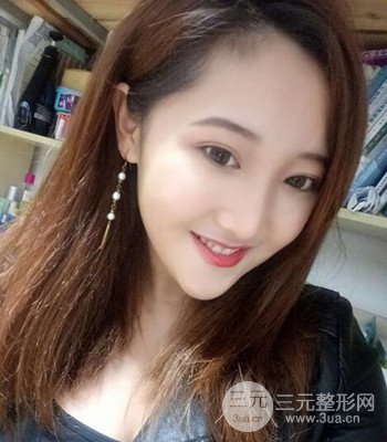 終于做了下頜角整形，分享術(shù)后恢復(fù)果
