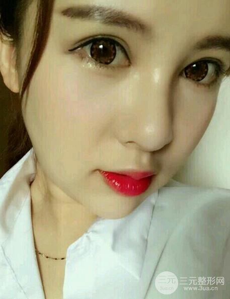 隆鼻整形手術(shù)個(gè)人經(jīng)歷分享,精致小翹鼻不是夢(mèng)