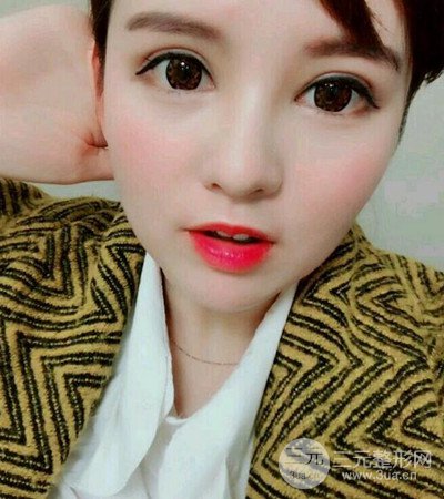 隆鼻整形手術(shù)個(gè)人經(jīng)歷分享,精致小翹鼻不是夢(mèng)