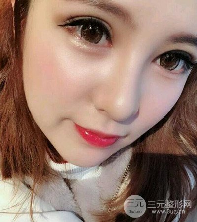 隆鼻整形手術(shù)個(gè)人經(jīng)歷分享,精致小翹鼻不是夢(mèng)