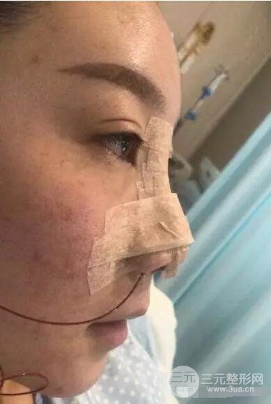 北京伊美爾徐軍隆鼻整形前后對(duì)比照片心情記錄小札