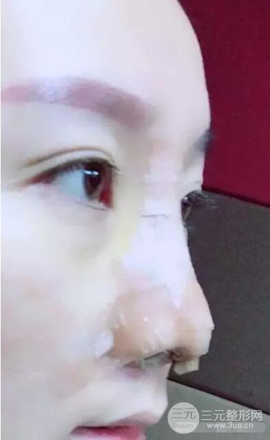 北京伊美爾徐軍隆鼻整形前后對(duì)比照片心情記錄小札