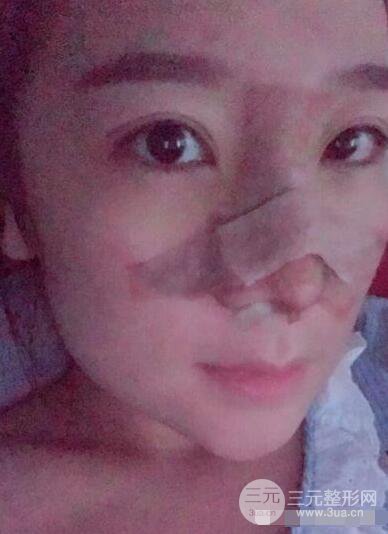 北京伊美爾徐軍隆鼻整形前后對(duì)比照片心情記錄小札