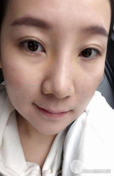 北京伊美爾徐軍隆鼻整形前后對(duì)比照片心情記錄小札