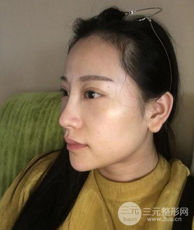內(nèi)切微創(chuàng)去眼袋手術(shù)案例分享,附上手術(shù)恢復(fù)照片