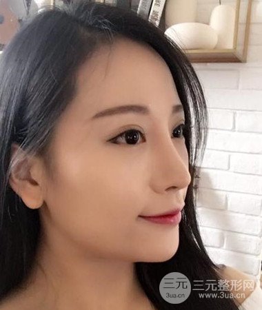 內(nèi)切微創(chuàng)去眼袋手術(shù)案例分享,附上手術(shù)恢復(fù)照片