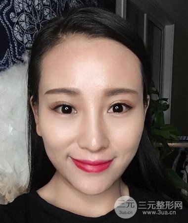 內(nèi)切微創(chuàng)去眼袋手術(shù)案例分享,附上手術(shù)恢復(fù)照片