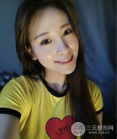 內(nèi)切微創(chuàng)去眼袋手術(shù)案例分享,附上手術(shù)恢復(fù)照片