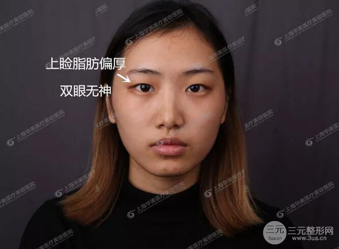 上海華美楊亞益全切雙眼皮案例對比圖 男女雙眼皮案例混搭