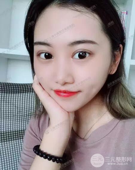 上海華美楊亞益全切雙眼皮案例對比圖 男女雙眼皮案例混搭