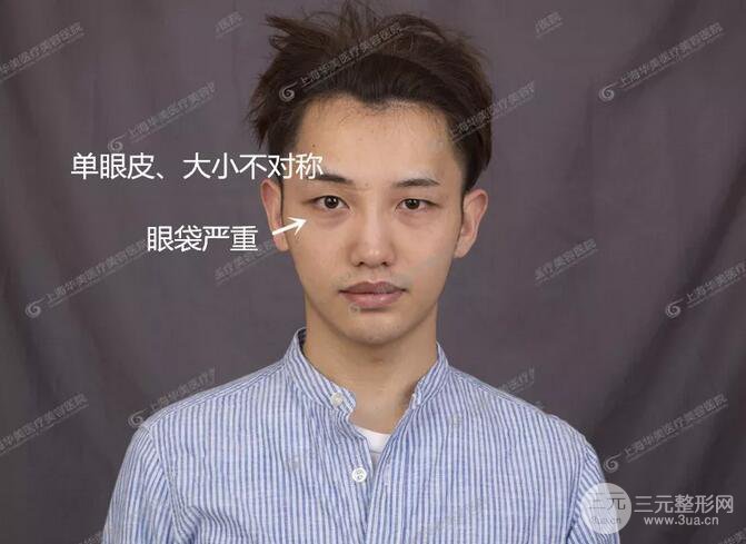 上海華美楊亞益全切雙眼皮案例對比圖 男女雙眼皮案例混搭