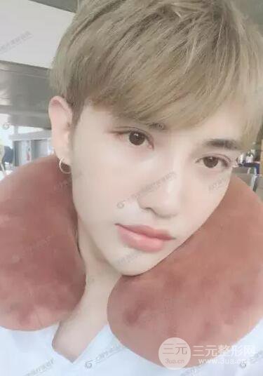 上海華美楊亞益全切雙眼皮案例對比圖 男女雙眼皮案例混搭