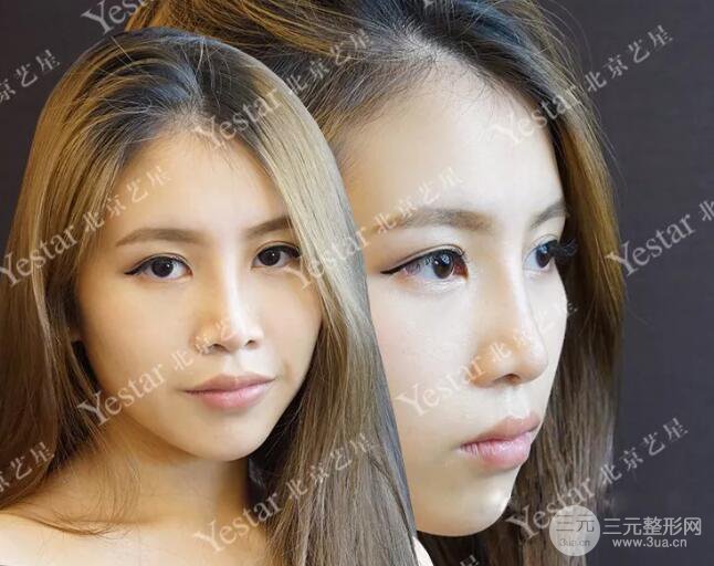 北京藝星仇侃敏耳軟骨隆鼻恢復(fù)過程|內(nèi)附前后對(duì)比圖