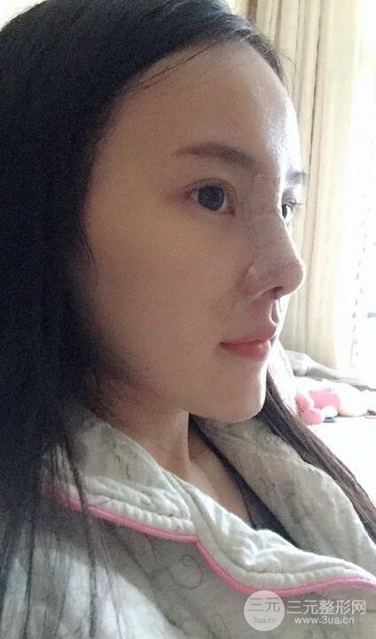 成都大華隆鼻怎么樣?真實案例前后對比圖記錄恢復(fù)過程