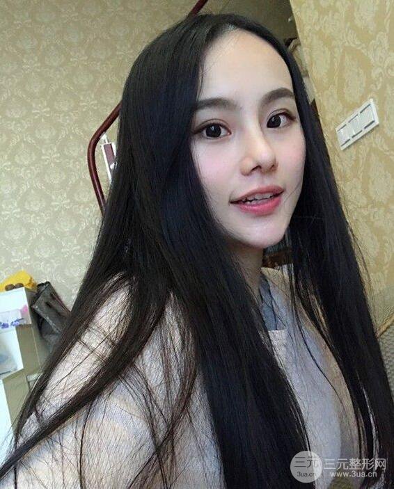 成都大華隆鼻怎么樣?真實案例前后對比圖記錄恢復(fù)過程