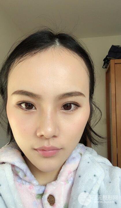成都大華隆鼻怎么樣?真實案例前后對比圖記錄恢復(fù)過程