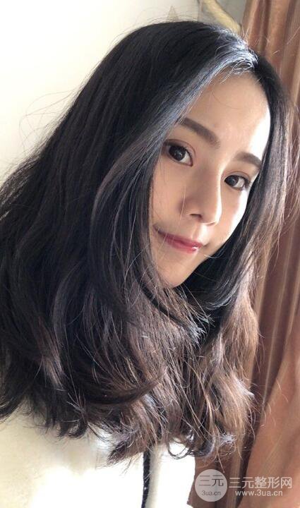 成都大華隆鼻怎么樣?真實案例前后對比圖記錄恢復(fù)過程