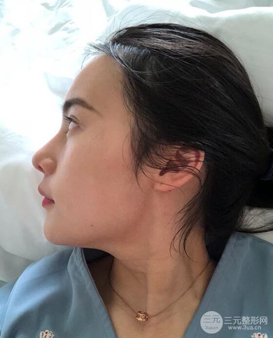 成都大華隆鼻怎么樣?真實案例前后對比圖記錄恢復(fù)過程
