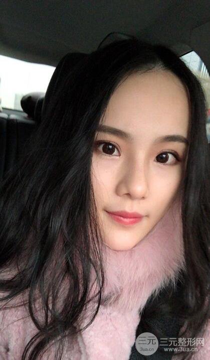 成都大華隆鼻怎么樣?真實案例前后對比圖記錄恢復(fù)過程