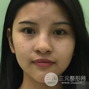 成都華西醫(yī)院整形美容科卿勇隆鼻整形前后對(duì)比圖恢復(fù)心情小札