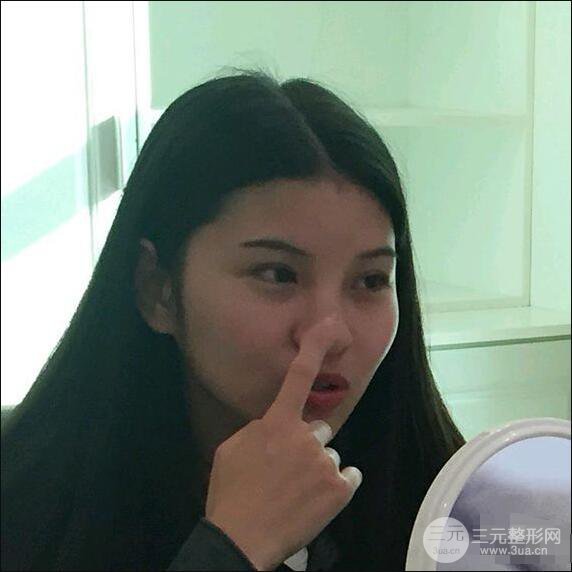 成都華西醫(yī)院整形美容科卿勇隆鼻整形前后對(duì)比圖恢復(fù)心情小札