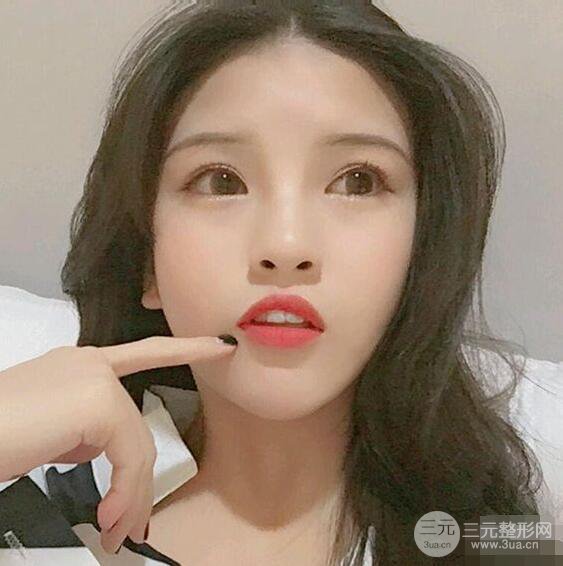 成都華西醫(yī)院整形美容科卿勇隆鼻整形前后對(duì)比圖恢復(fù)心情小札