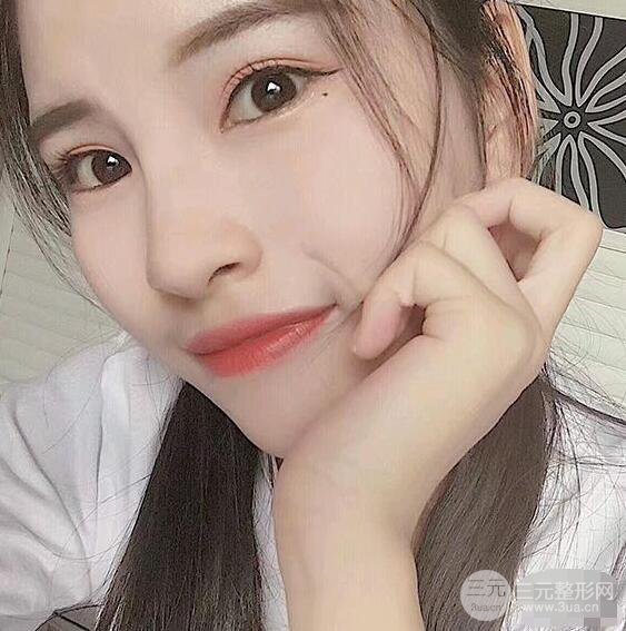 成都華西醫(yī)院整形美容科卿勇隆鼻整形前后對(duì)比圖恢復(fù)心情小札