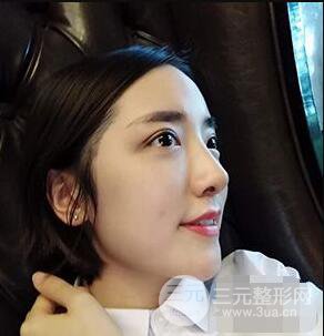 杭州格萊美張樹功假體隆鼻前后對比圖|內(nèi)附恢復(fù)心情變化哦