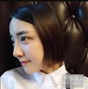 杭州格萊美張樹功假體隆鼻前后對比圖|內(nèi)附恢復(fù)心情變化哦